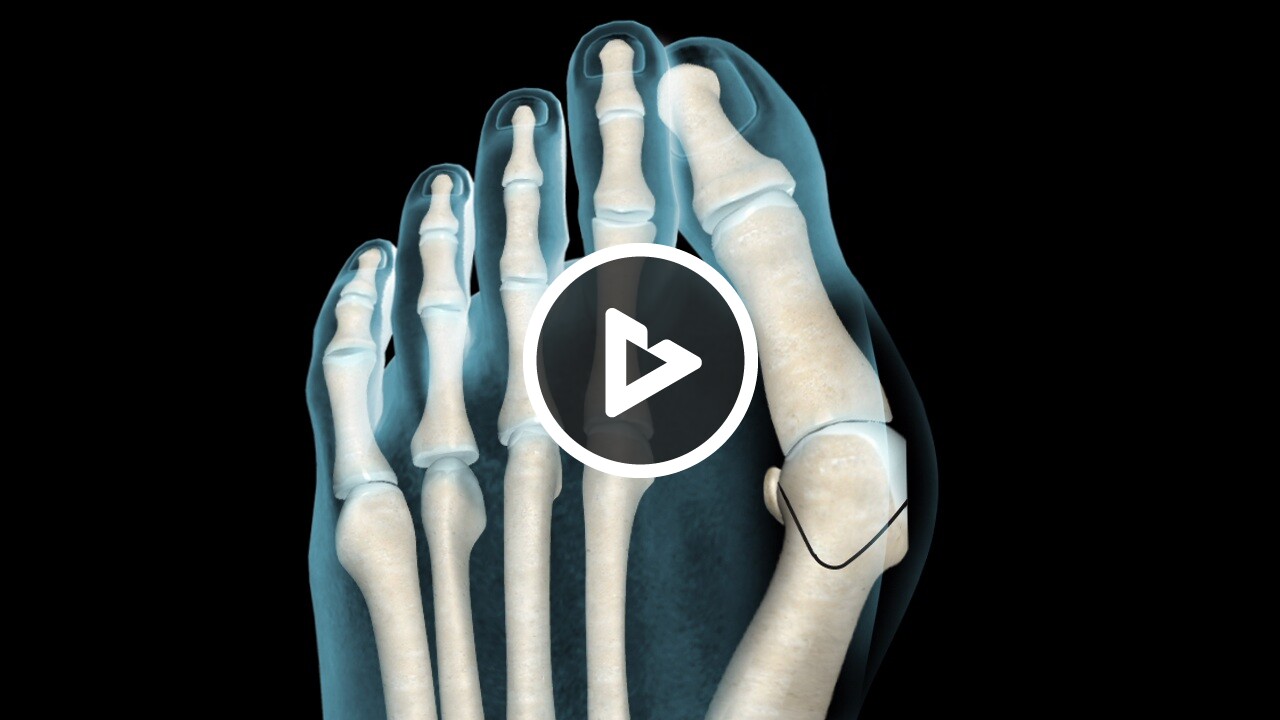 Bunionectomy (Chevron Bunionectomy) Foot and Ankle Willis Knighton
