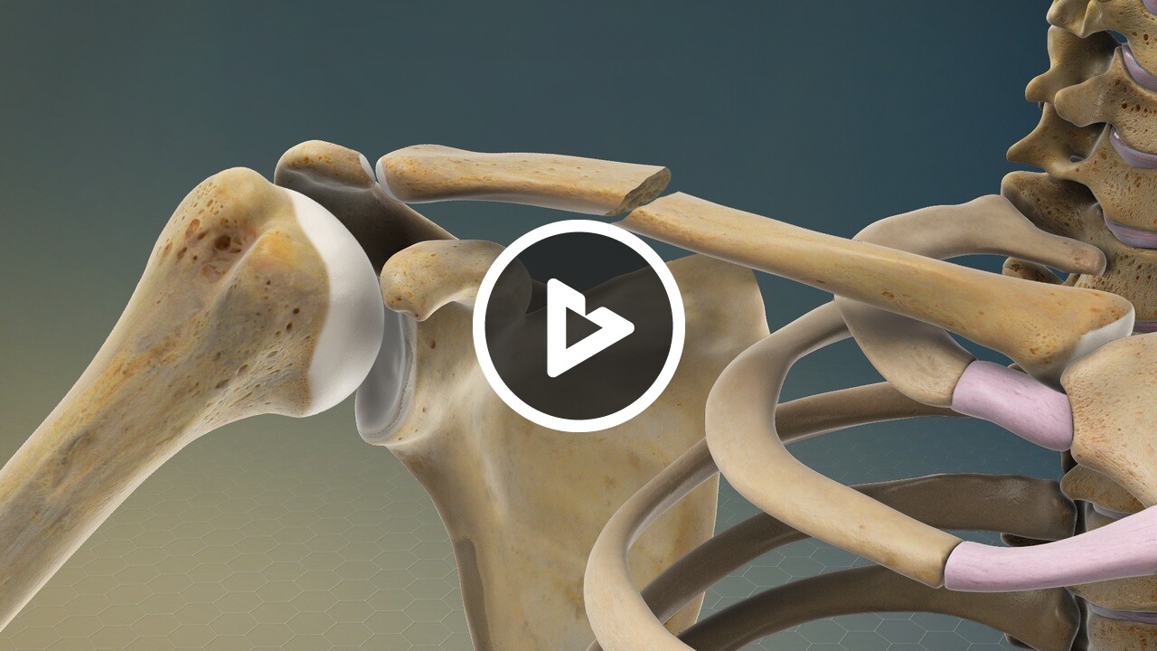 Clavicle Fracture (Broken Collarbone) - Upper Extremity (Arms and Hands ...